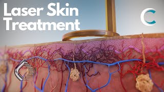 Next Generation Laser Treatment of Skin Lesions and Pigmentation by Candela 3D medical animation [upl. by Asirrac]