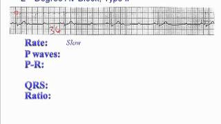 ECG 2nd Degree AV Block Type 2 [upl. by Annaya]