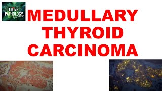 MEDULLARY THYROID CARCINOMA  Gross Microscopic amp Clinical features [upl. by Aleacim897]