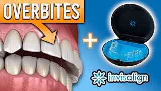 Can Invisalign FIX Overbites amp Other Bite Problems  Premier Orthodontics [upl. by Kingsbury]