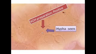 KOH positive  Fungal elements seen  Sputum  hyphae [upl. by Janetta835]