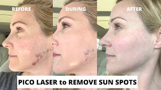 Pico Laser Treatment to Remove Sun Spots Before and After  With Dr Stefani Kappel MD EP039 [upl. by Aiyotal]