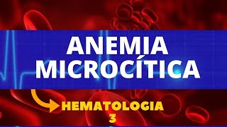 ANEMIA MICROCÍTICA  HEMATOLOGIA  AULA 3 [upl. by Marteena]