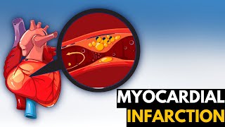 Myocardial Infarction Causes Signs and Symptoms Diagnosis and Treatment [upl. by Eldwen]