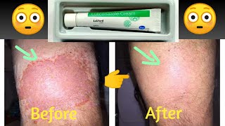 Luliford Cream For Fungal Infections  Luliconazole Ointment For Fungal Infections Completely Cure [upl. by Sherry354]