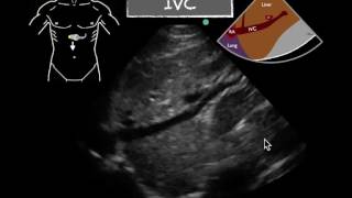 POCUS Cardiac IVC Respiratory variation [upl. by Samuelson520]