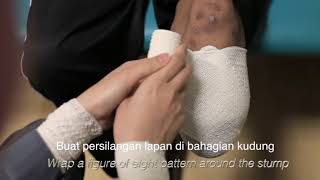 Stump bandaging techniques [upl. by Burdett]