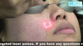 Laser Acne Scars [upl. by Keever]