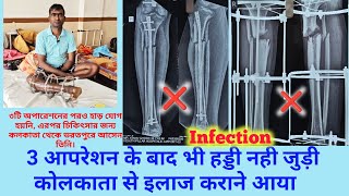 tibia fibula and femur fracture ilizarov surgery fail kolkata se bharatpur ilaaj ke liye aaya [upl. by Evered]