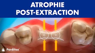 Atrophie post extraction dentaire © [upl. by Ninnette]