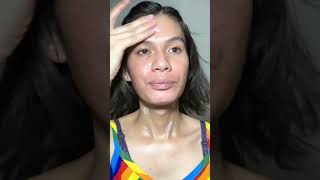 Day 5  TCA CROSS TREATMENT  CHEMICAL PEEL  MICRONEEDLING  ACNE SCARS TREATMENT youtubeshorts [upl. by Martelli845]