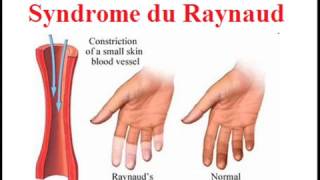 Syndrome de Raynaud [upl. by Tiffi53]