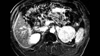 Paraganglioma [upl. by Wolfgram]