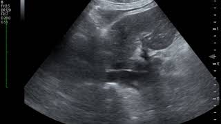 Thrombus in IVC Ultrasound JETem 2018 [upl. by Siloum]