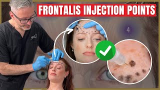 Injecting the Frontalis  Botox Injection Points amp Safety Advice [upl. by Achilles675]