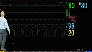 Philips IntelliVue Patient Monitoring  1  Introduction to Basic Operation [upl. by Buiron]