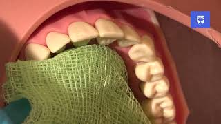 Management of an avulsed permanent tooth [upl. by Nohsid]