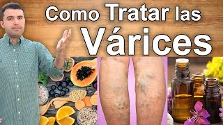 COMO ELIMINAR LAS VARICES PARA SIEMPRE  Tratamientos Naturales Para las Várices en las Piernas [upl. by Ominoreg]