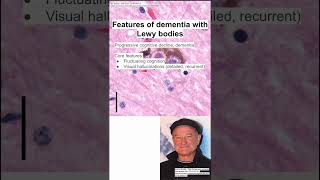 Features of dementia with Lewy bodies [upl. by Atneciv]