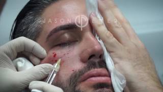 Belotero Fillers For Under Eye Hollows Dark Circles And Eye Bags  Dark Circle Treatment Live [upl. by Aidnis552]