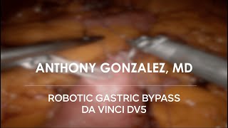 Robotic Gastric Bypass  da Vinci DV5 [upl. by Mulac]