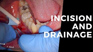 2 Molar Root Canals Pulpectomy Incision and Drainage and a 1 Step [upl. by Noakes]