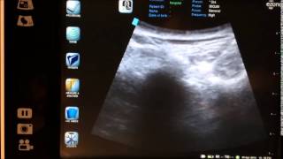 ultrasound guided bilateral SI joint injection  sacroilliac joint injection [upl. by Aerua]