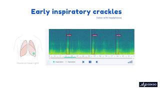 Lung sounds  Early inspiratory crackles [upl. by Noroj]