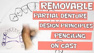 Removable Partial Denture Design Penciling on Cast [upl. by Sallyanne]