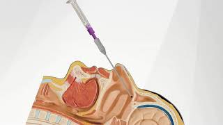 The SphenoCath® Procedure [upl. by Ativet]