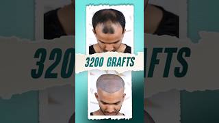 3200 Grafts Hair Transplant  Bangladesh hairtransplant hairtransplantation bangladesh shorts [upl. by Estas]