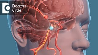 What is the recovery time for Brain Aneurysm  Dr Tejus MN Rao [upl. by Phillipe]