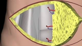 Breast Reconstruction  DIEP procedure Narration and Animation by Cal Shipley MD [upl. by Eitirahc]