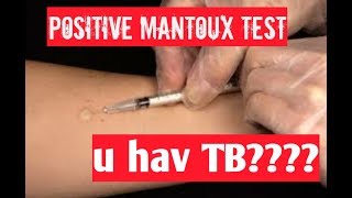 positive mantoux test tuberculin test positive result means [upl. by Amaris694]