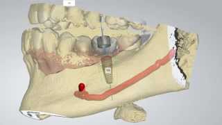 Digital Implant Dentistry [upl. by Aprilette686]