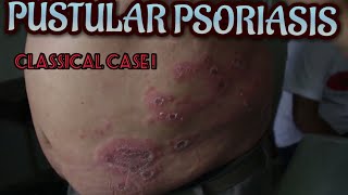 Dermatology  Pustular Psoriasis  Dr Suchana Marahatta  नेपालीमा [upl. by Hyacinthe]