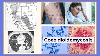 coccidioidomycosis [upl. by Ttekcirc634]