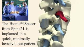 New treatment of Lumbar Spinal Stenosis [upl. by Dirraj]