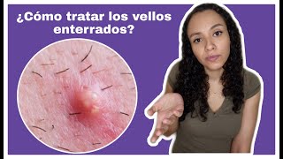 ¿VELLOS ENTERRADOS   FOLICULITIS [upl. by Millhon288]