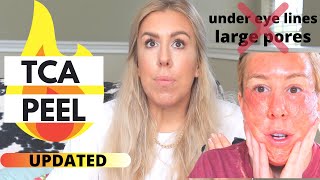 How to do chemical peel AT HOME Updated 30 percent TCA peel for under eye lines and large pores [upl. by Akili626]