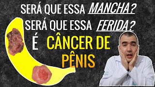 Como saber se uma Ferida ou Mancha é CÂNCER DE PÊNIS [upl. by Mikkanen]