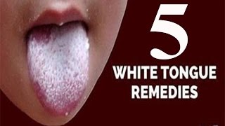 5 Home Remedies for a WhiteCoated Tongue  By Top 5 [upl. by Yemane]