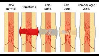 Consolidação Óssea das Fraturas FASES do CALO ÓSSEO  Clínica de Fisioterapia Dr Robson Sitta [upl. by Warring]