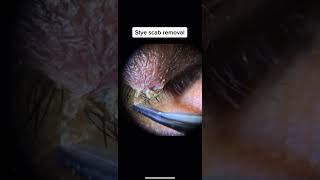 Stye Scab Removal [upl. by Willi]