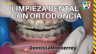 ⏮️ LIMPIEZA DENTAL👅Con ORTODONCIA BRACKETS dentalhygiene dentalcare [upl. by Sidell828]