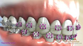 Orthodontic Braces  Different Parts 2 [upl. by Rofotsirk665]