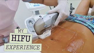 🔥Ultraformer 3 HIFU Body Treatment My Transformation with HighIntensity Focused Ultrasound 🌟 [upl. by Shaner]