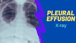 Imaging of pleural effusion For medical students clinicans and residents [upl. by Alcott]