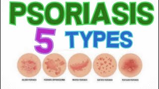 THE 5 MAIN TYPES OF PSORIASIS  PSORIASIS CLASSIFICATION [upl. by Bordiuk]