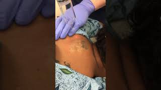 PiQo4 Advanced Laser Tattoo Removal [upl. by Htebyram234]